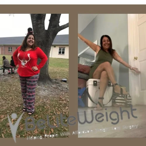 Weight Loss Surgery Gastric Sleeve before and after